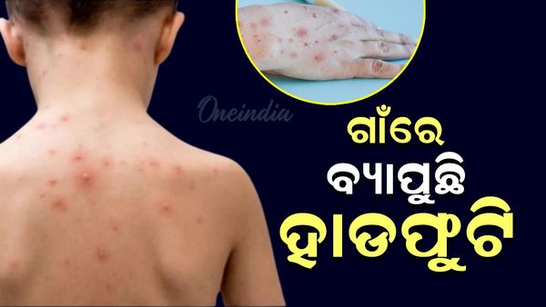 ଏହି ଜିଲ୍ଲାରେ ବ୍ୟାପୁଛି ହାଡ଼ଫୁଟି, ୧୦ ଜଣ ଶିଶୁ ଆକ୍ରାନ୍ତ
