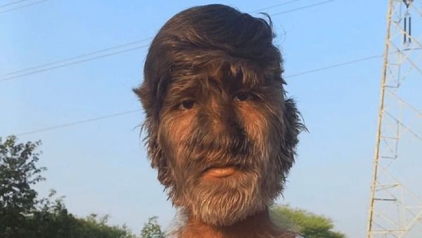 ମୁହଁରେ ଅଧିକ କେଶ ପାଇଁ ବିଶ୍ୱ ରେକର୍ଡ