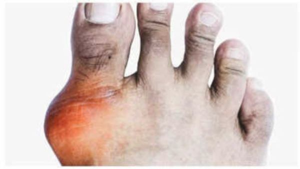 Uric Acid: ରାତିରେ କାହିଁକି ବଢ଼େ ୟୁରିକ୍ ଏସିଡ୍ ? ୬ଟି ସଙ୍କେତ ଖରାପ