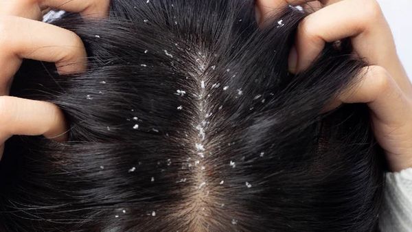 ଆପଣାନ୍ତୁ ଏହି ଘରୋଇ ଉପାୟ,ଗୋଟିଏ ସପ୍ତାହ ମଧ୍ୟରେ ରୁପିରୁ ମିଳିବ ମୁକ୍ତି!