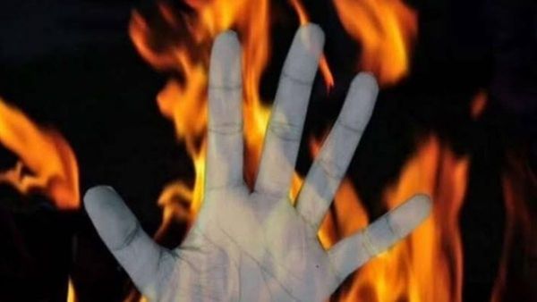 ନାବାଳିକାର ଶରୀର ଉପରିଭାଗ ପ୍ରାୟ ୭୦% ପୋଡ଼ିଛି: ଏମସ