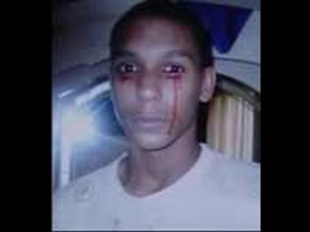 கண்களிலிருந்து வடியும் ரத்தம் - தவிக்கும் யு.எஸ். சிறுவன்