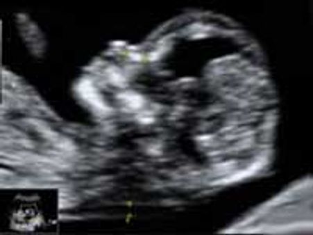 'டவுன்ஸ் சிண்ட்ரோம்'-கருவுற்ற காலத்தி்ல் ஸ்கேன் அவசியம்