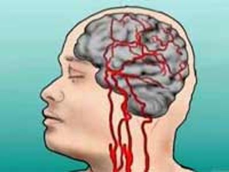 2015ல் பக்கவாதத்தால் 17 லட்சம் பேர் பாதிக்கப்படுவர்