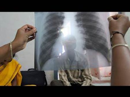 உலகிலேயே இந்தியாவில்தான் டிபி பாதிப்பு அதிகம்- 25 லட்சம் பேர் பாதிப்பு: ஹூ