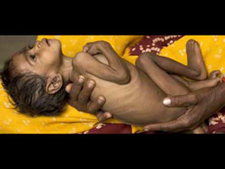 2010ல் ம.பி.யில் 1.08 லட்சம் பச்சிளம் குழந்தைகள் பட்டினிச் சாவு