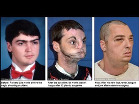 சிதைந்த முகத்திற்கு பதில் புதிய முகம்: அமெரிக்காவில் சாதனை !