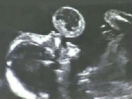 மியாமி: 17 வார கருவின் வாயில் இருந்த புற்றுநோய்க் கட்டி அகற்றம்