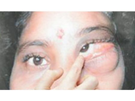 கண்ணுக்குள் வளர்ந்திருந்த 2 பற்கள்.. ஆந்திர பெண்ணுக்கு சென்னையில் அறுவை சிகிச்சை