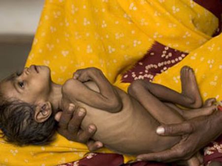 இந்தியாவில் 70 சதவீதம் குழந்தைகளுக்கு ஊட்டச்சத்து குறைபாடு: அதிர்ச்சித் தகவல்