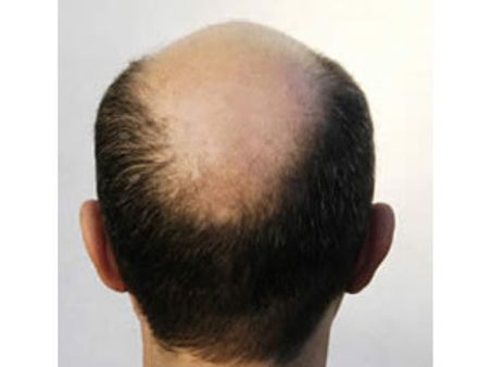 தலை வழுக்கை விழுதா? மாரடைப்பு வரும் வாய்ப்பு அதிகமாம்...