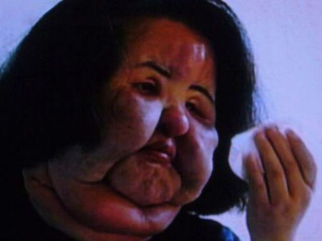 சமையல் எண்ணெயையும் சிலிகானையும் ஊசி மூலம் முகத்தில் ஊற்றி… அழகுக்கு ஆசைப்பட்டு அவதிப்படும் மாடல்