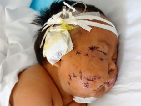 சீனாவில் பால் குடிக்கையில் மார்பை கடித்த குழந்தையை கத்திரியால் 90 முறை குத்திய தாய்