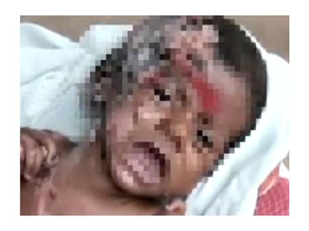 ‘தீ’ பிடித்து எரியும் அதிசய குழந்தை: சென்னையில் தீவிர சிகிச்சை!