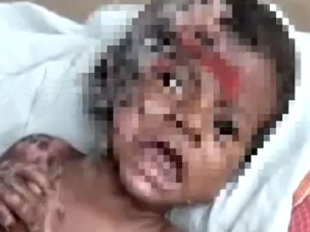 குழந்தை தானாக தீப்பிடித்து எரியவில்லை... யாரோ எரித்துள்ளனர்... டாக்டர்கள் தகவலால் பரபரப்பு