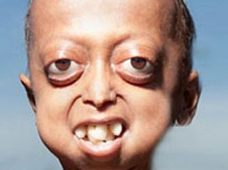 இந்த பீகார் சிறுவனுக்கு வயதோ 14, தோற்றத்திற்கோ வயது 110