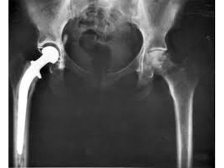 103 வயது தாத்தாவுக்கு ‘இடுப்பு எலும்பு மாற்று அறுவைச் சிகிச்சை’: ஆந்திர மருத்துவர்கள் சாதனை