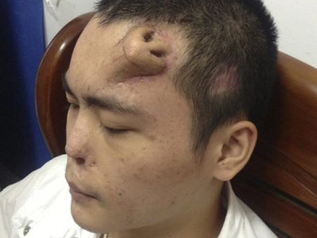 ஸ்டெம்செல்தெரபி மூலம் நெற்றியில் வளர்ந்த ‘புதிய மூக்கு’: சீன மருத்துவர்கள் சாதனை