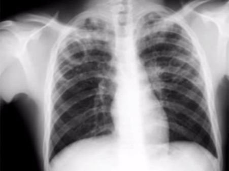 இந்தியாவில் 10 லட்சம் பேருக்கு டிபி!