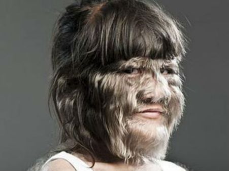 முகம் முழுவதும் முடியுடன் வாழும் 14 வயது தாய்லாந்து சிறுமி... கின்னசில் இடம் பிடித்தார்