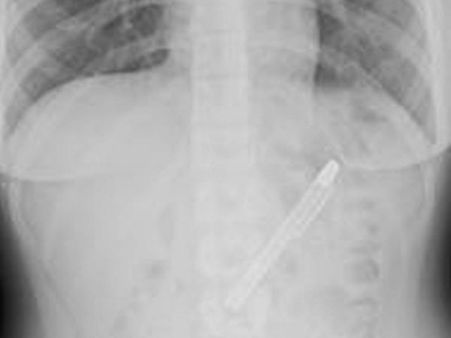 என்னாச்சு? பரீட்சை எழுதினேன்! தண்ணி அடிச்சேன்! ஓ.. பேனாவை முழுங்கிட்டேனா?