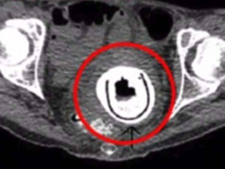 10 வருடமாக பெண்ணுறுப்புக்குள் சிக்கியிருந்த செக்ஸ் பொம்மை...!
