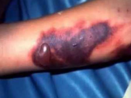 'எபோலா' வைரஸ் தாக்காமல் இருக்க என்ன செய்வது?