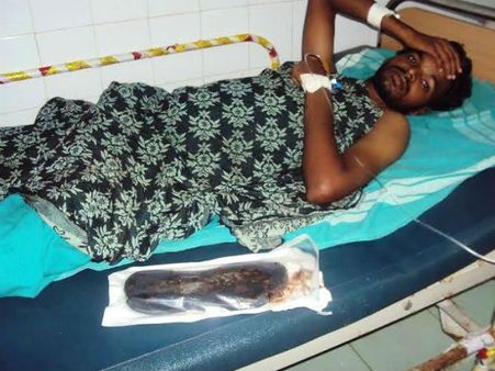 நெல்லை வாலிபர் வயிற்றில் இருந்த லேடீஸ் செருப்பு ஆபரேஷன் மூலம் அகற்றம்!