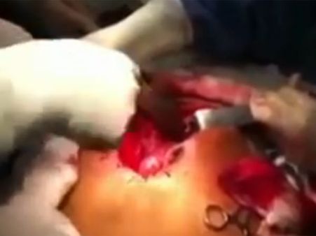 மனிதனில் குடலுக்குள் உயிருடன் குடித்தனம் நடத்திய மீன்- அறுவை சிகிச்சை மூலம் அகற்றம்!