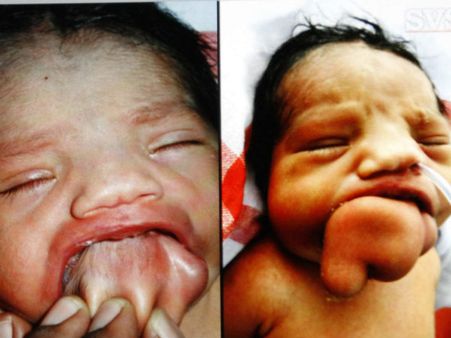 பிறந்த குழந்தையின் வாயில் 50 கிராம் கட்டி: ஆபரேசன் மூலம் அகற்றம்