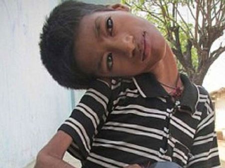 கழுத்தில் நிற்காமல் தொங்கும் 12 வயது சிறுவனின் தலை: ஆபரேஷன் செய்ய முன்வந்துள்ள டாக்டர்