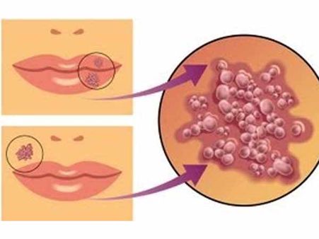 புற்று நோயைக் குணப்படுத்த “வைரஸ் இம்யுனோ தெரபி”- விஞ்ஞானிகளின் புதிய கண்டுபிடிப்பு