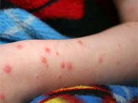 கத்திரி முடிந்தும் கலங்கடிக்கும் வெயில்- அச்சுறுத்தும் அம்மை நோய்!