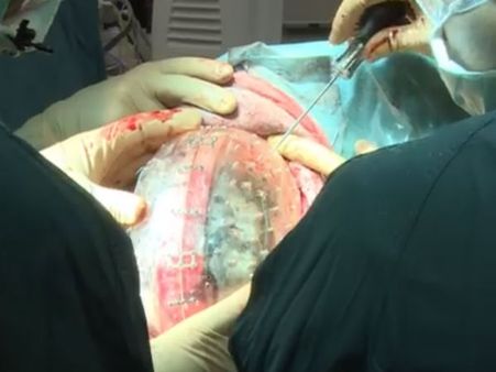 மண்டை ஓடு மாற்று அறுவை சிகிச்சை – அமெரிக்க மருத்துவர்கள் சாதனை!