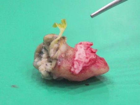 ஆ.. தைவான் நபரின் பல்லில் முளை விட்ட கொய்யா!