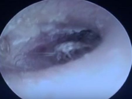 வாலிபரின் காதுக்குள் குடியேறி குடும்பம் நடத்திய கரப்பான் பூச்சி!