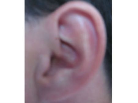 செஷல்ஸ் நாட்டு சிறுவனுக்கு காது மாற்று அறுவை சிகிச்சை - சென்னை மருத்துவர் சாதனை