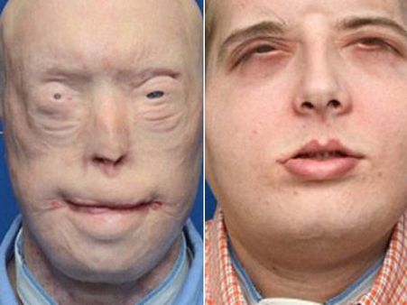 யு.எஸ்.: முன்னாள் தீயணைப்பு படை வீரருக்கு வெற்றிகரமாக நடந்த முகமாற்று அறுவை சிகிச்சை