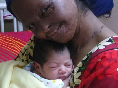 தாய்மைக்கு அழகு தேவையில்லை... ஆசிட் வீச்சில் பாதித்த லட்சுமிக்கு பிறந்த தேவதை
