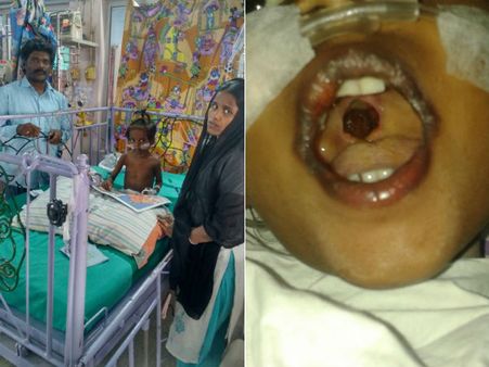 தொண்டையில் ஓட்டை.. சிகிச்சைக்கு நிதியில்லாமல் தவிக்கும் 5 வயது சிறுமி!