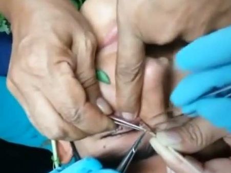 மேட்டூர் அரசு மருத்துவமனையில்ர் அரசு மருத்துவமனையில் ஆபரேசன் செய்த 20 பேருக்கு பார்வை பறிபோனது