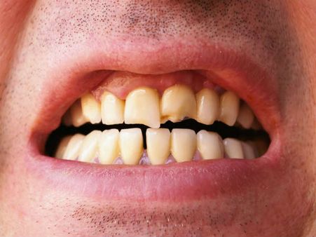 தூக்கத்தில் பற்களை நறநறன்னு கடிப்பிங்களா.. அப்படின்னா இதப் படிங்க முதல்ல