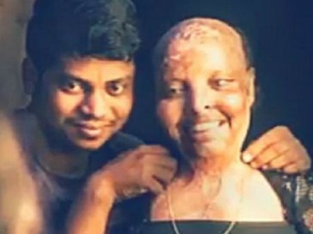 ஆசிட் வீச்சில் பாதிக்கப்பட்ட பெண்.. கரம்பிடித்த மருத்துவ பணியாளர்.. ஒடிசாவில் ஸ்வீட் காதலர் தினம்
