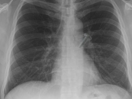 இன்று காசநோய் விழிப்புணர்வு தினம் : காசநோய் பாதிப்பை தடுக்க சந்திரனை வணங்குங்க!