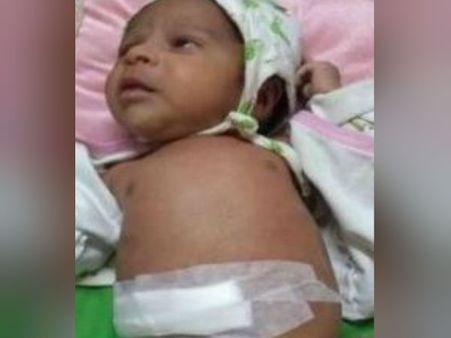 வயிற்றில் கரு.. அரியவகை பிரச்சினையுடன் பிறந்த ஆண் குழந்தை... அறுவை சிகிச்சை மூலம் அகற்றம்