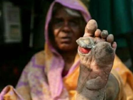 பாதங்கள் கொப்பளித்து வெடித்து....ரத்தம் சொட்ட சொட்ட நடந்து வந்த மகாராஷ்டிரா விவசாயிகள்!