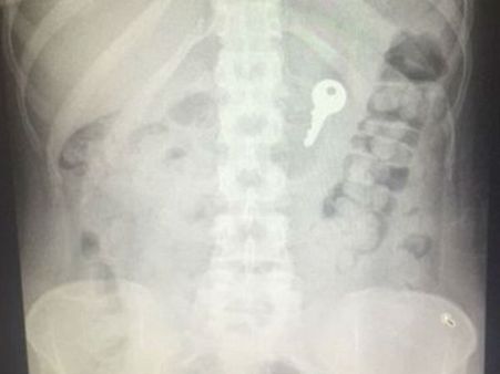 திருமணமாகவில்லை... ‘சூனியம்’ பயம்.. மந்திரவாதி ஆலோசனைப்படி சாவி, வயரை விழுங்கிய நபர்!