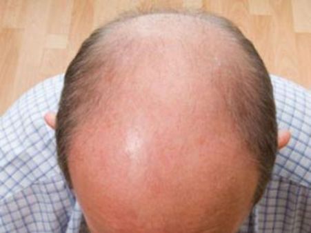 இதற்கெல்லாமா தற்கொலை செய்வது… வழுக்கைக்காக வாழ்க்கையை இழக்கலாமா?