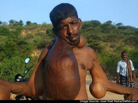 18கிலோ எடை கொண்ட மெகா சைஸ் கட்டிகள்.. மருத்துவ உதவி வேண்டி நிற்கும் தர்மபுரி பழனிச்சாமி