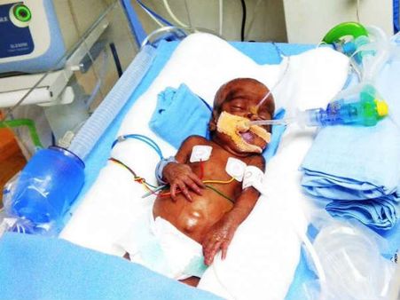 வளர்ச்சியடையாத நுரையீரலுடன் ஐசியூவில் போராடும் 3 மாத குழந்தை.. உதவிக்கரம் நீட்டினால் காப்பாற்றலாம்!